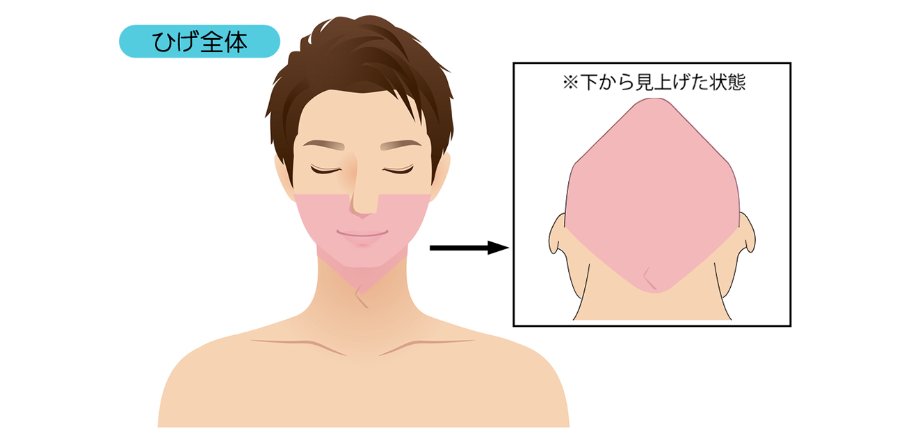 脱毛箇所 男性(ひげ全体)