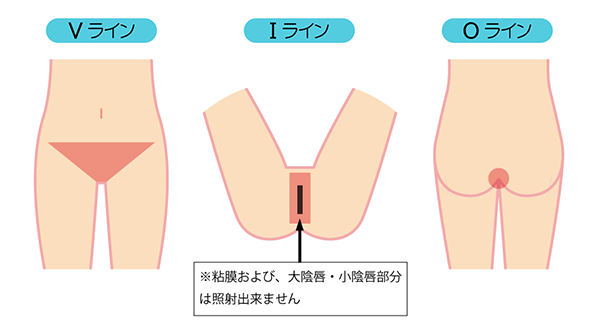 脱毛箇所 Vライン・Iライン・Oライン