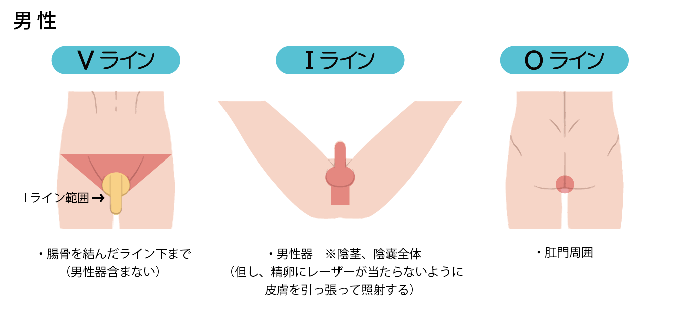 脱毛箇所 男性(Vライン・Iライン・Oライン)